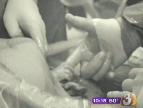 بالصور مولودة تمسك يد الطبيب وتخرج من رحم والدتها