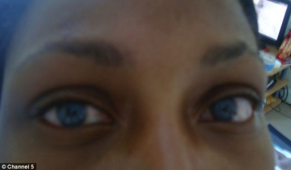 بالصور طالبة تصاب بالعمى بعد عملية لتغيير لون عينيها