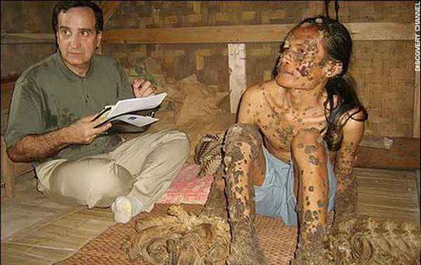 بالصور رجل أندونيسي يتحول الى شجرة بعد ان اصيب بفايروس hpv