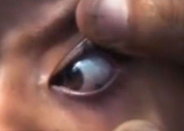 بالفيديو طفلة صغيرة تبكى حصى بدلا من الدموع في اليمن