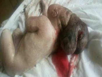 صور طفل حديث الولادة ب 3 رؤوس في جنوب لبنان