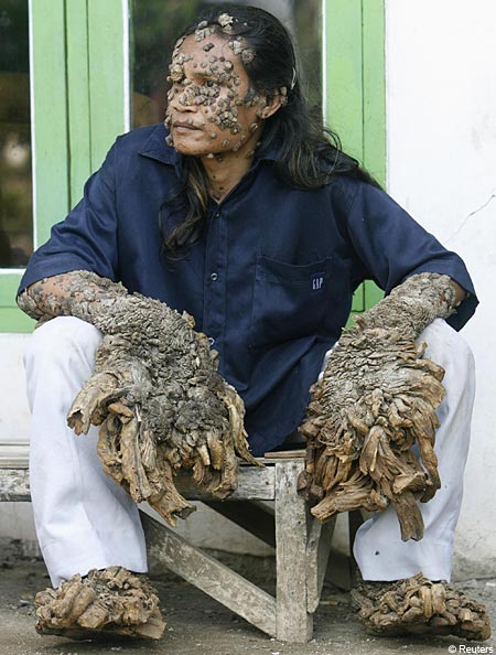 بالصور - رجل يتحول إلى شجرة بسبب مرض نادر