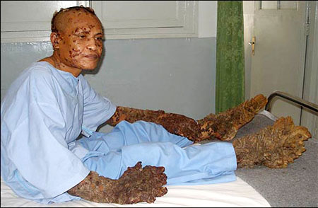 بالصور - رجل يتحول إلى شجرة بسبب مرض نادر