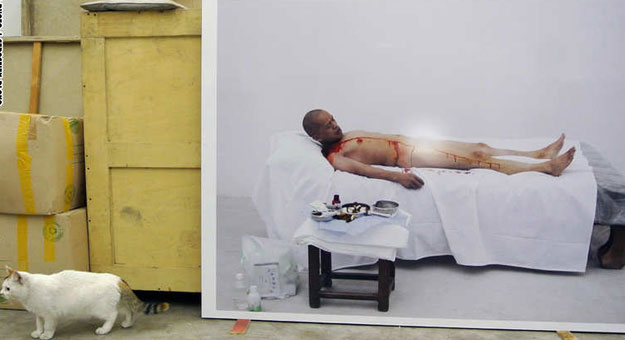بالصور صيني ينتزع ضلع من جسده بدون تدخل طبي
