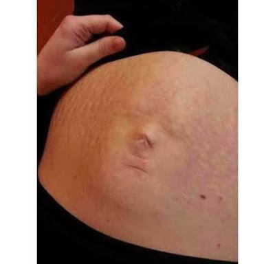 بالصور وجه الجنين مرسوم على بطن الأم 2014