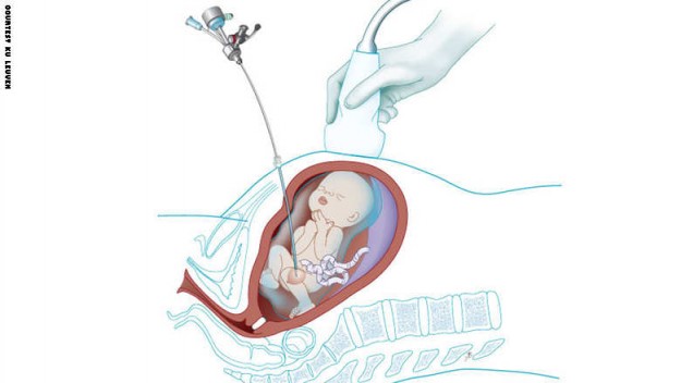بالصور روبوت صغير لعلاج الاختلالات الجينية قبل الولادة