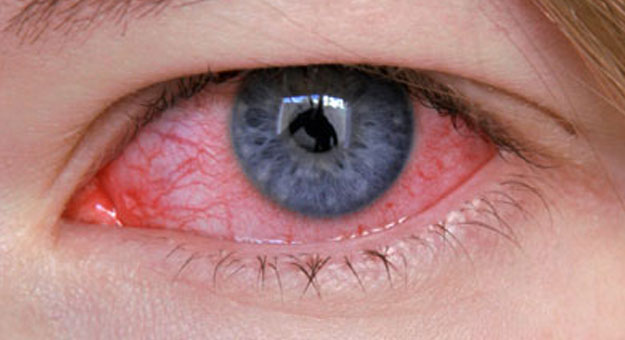 نصائح مهمة لعلاج احمرار العين