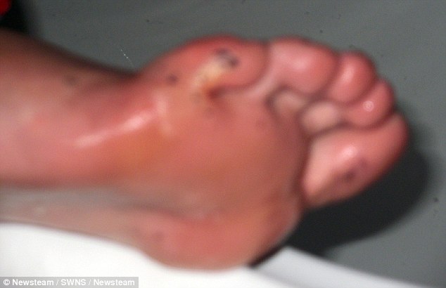 بالصور احتراق صبي بريطاني بانفجار جوال "بلاك بيري"